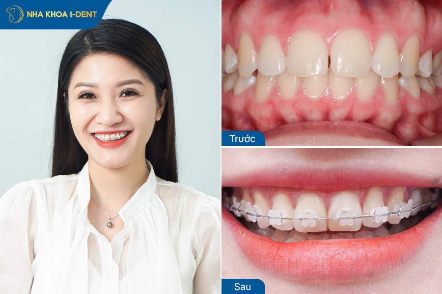 Hình ảnh sau khi niềng răng thưa