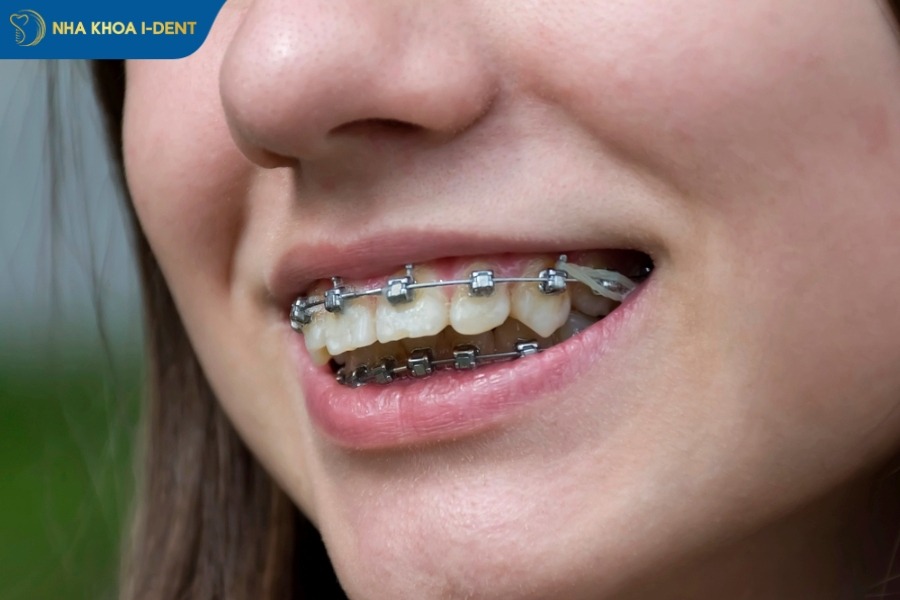 hô hàm có niềng răng được không