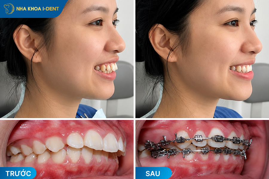 hô hàm trên có niềng răng được không