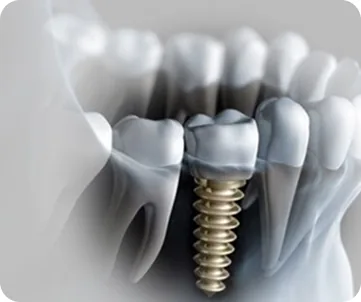 full set of dental implants