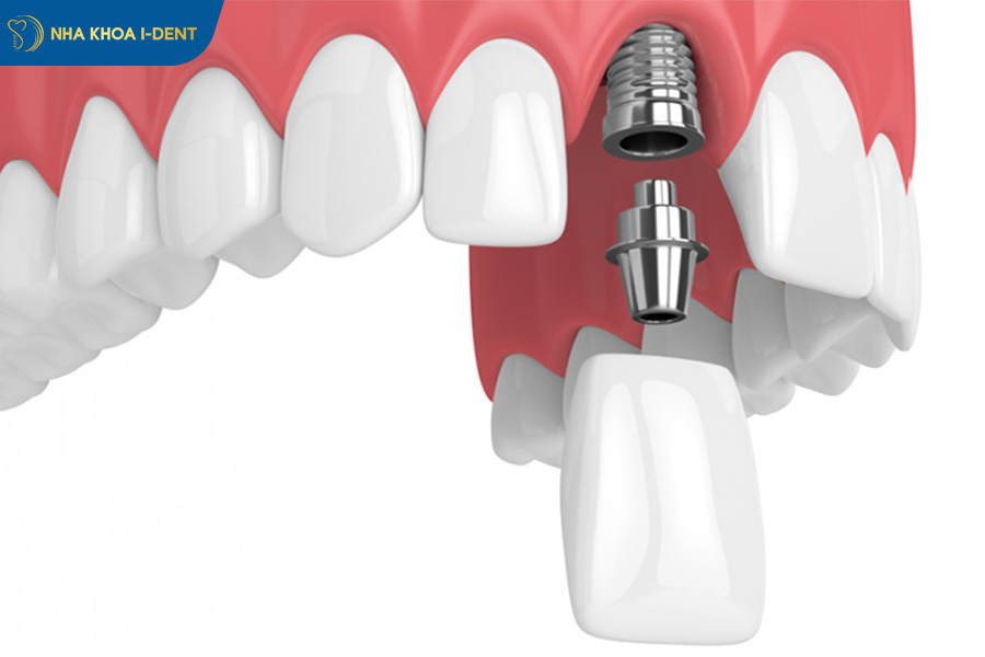 implant răng cửa