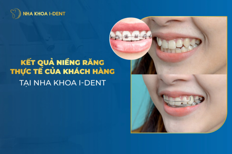 Kết quả niềng răng thực tế của khách hàng tại Nha khoa I-Dent