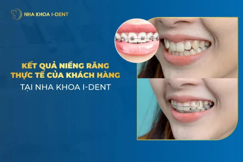 kết quả niềng răng
