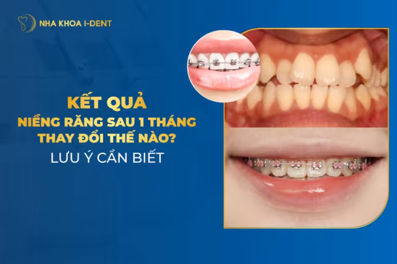 kết quả niềng răng sau 1 tháng