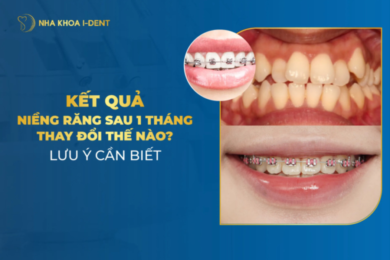 Kết quả niềng răng sau 1 tháng thay đổi như thế nào? Lưu ý quan trọng