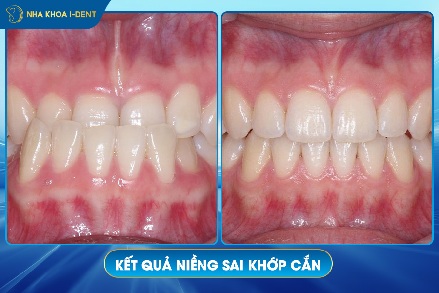 kết quả niềng răng trong suốt