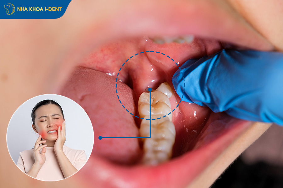 khi nào cần nhổ răng khôn