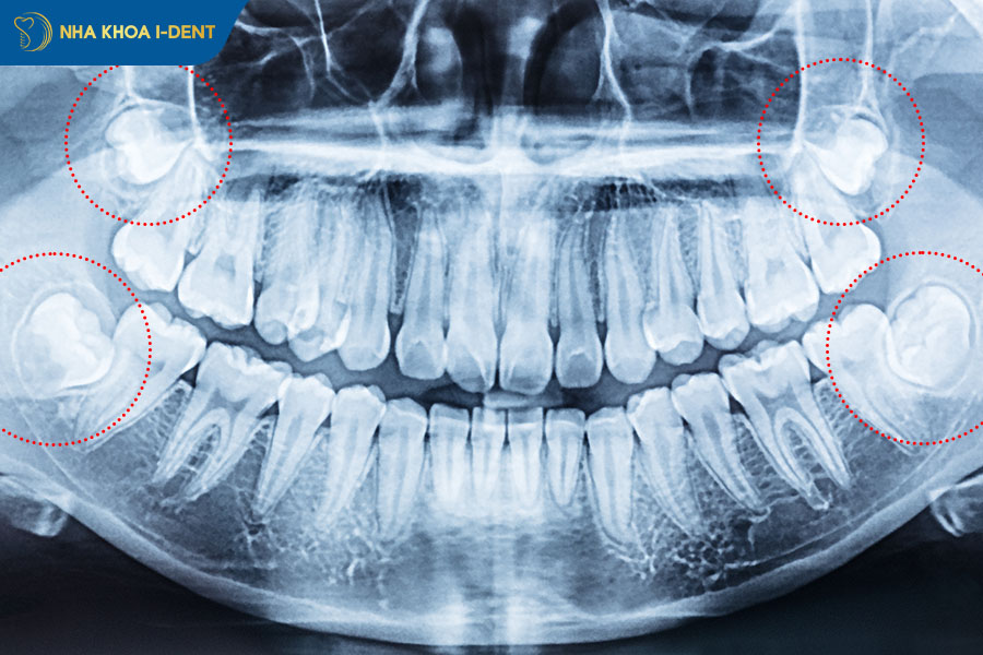 không nhổ răng khôn có được không