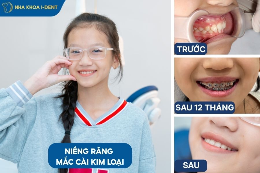 niềng răng khớp cắn sâu bằng mắc cài