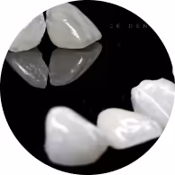 Miếng dán sứ Veneer Lingual.