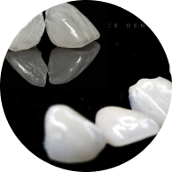 Miếng dán sứ Veneer Lingual.