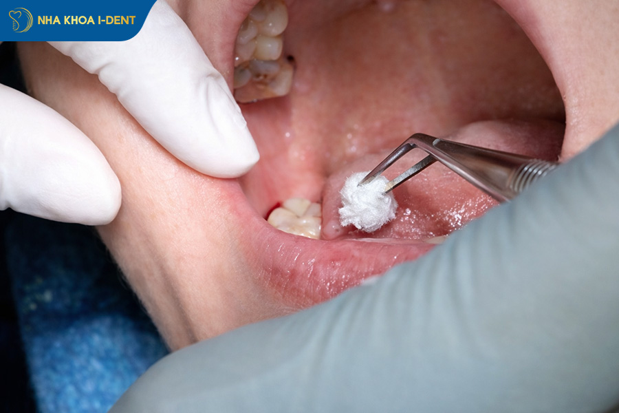 lớp màng trắng sau khi nhổ răng