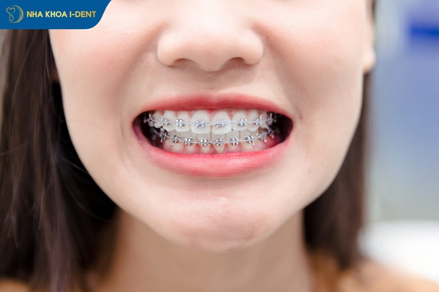 Lưu ý niềng răng không phải chỉ vì ngoại hình