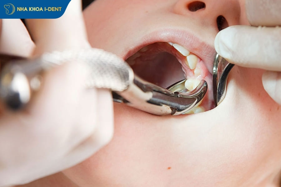 lưu ý khi niềng răng