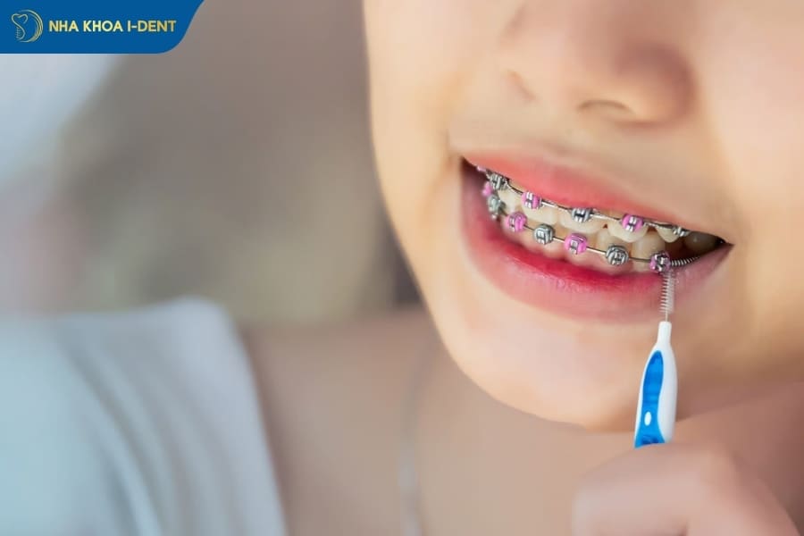 những lưu ý khi niềng răng