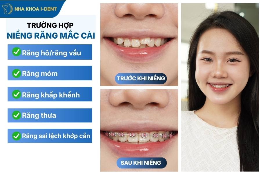 mắc cài niềng răng