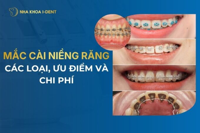 4 Loại Mắc Cài Niềng Răng Phổ Biến Nhất Hiện Nay