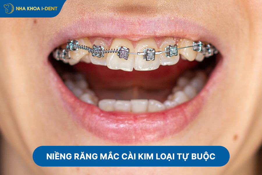 mắc cài tự động