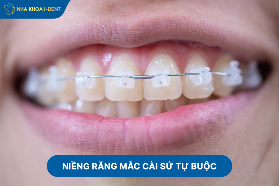niềng răng mắc cài tự động