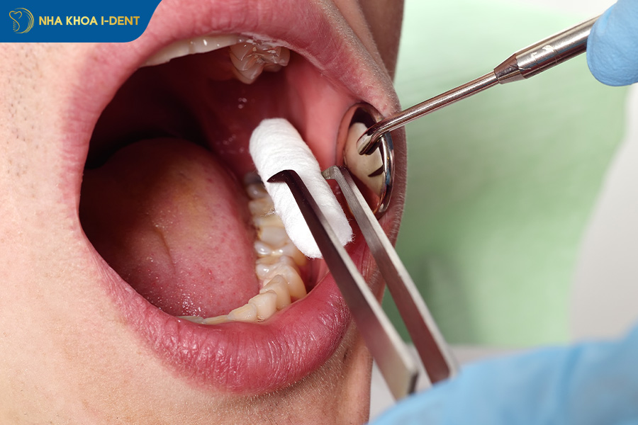 Màng màu trắng ở nướu sau nhổ răng