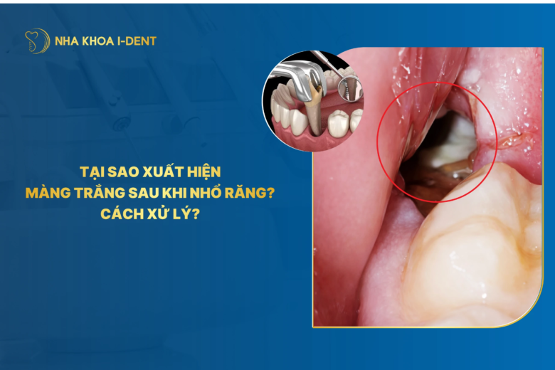 Tại sao xuất hiện màng trắng sau khi nhổ răng? Cách xử lý? 