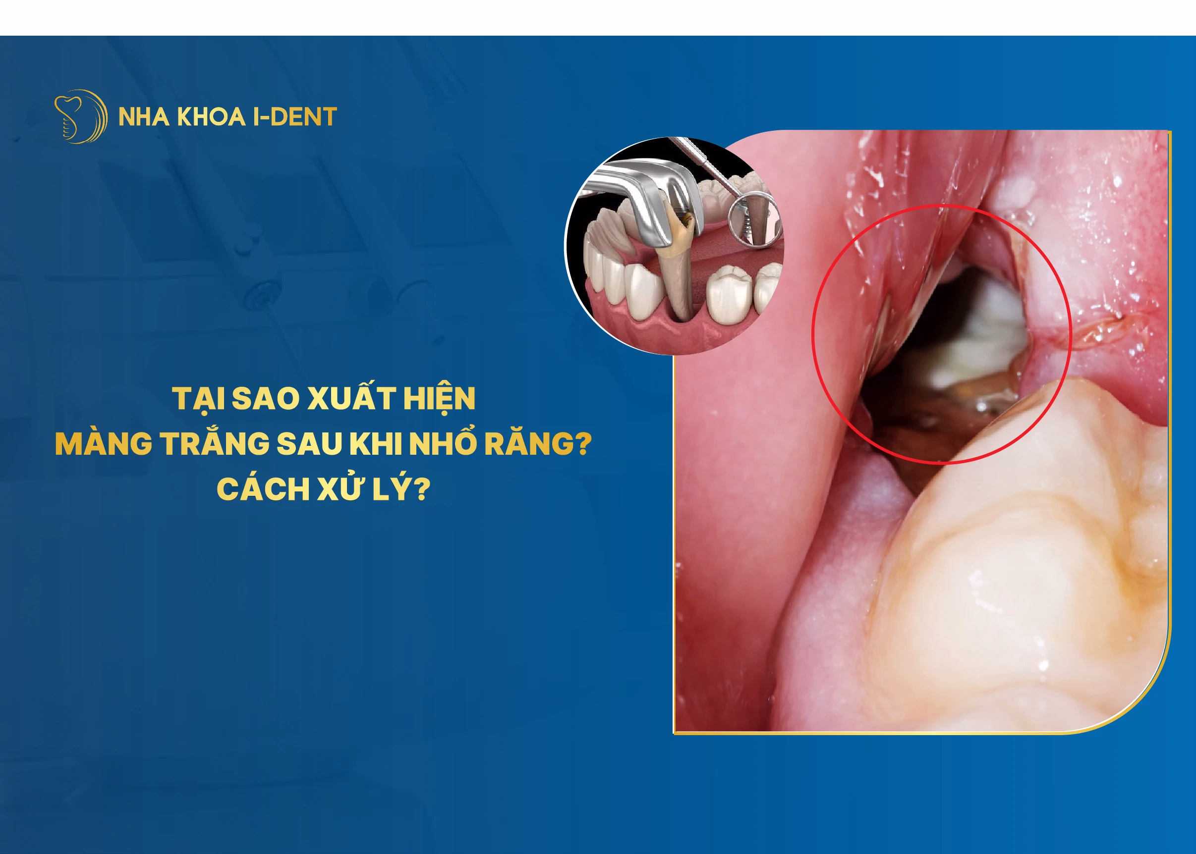 màng trắng sau khi nhổ răng