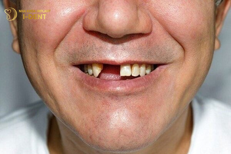nhổ răng bao lâu thì trồng lại được