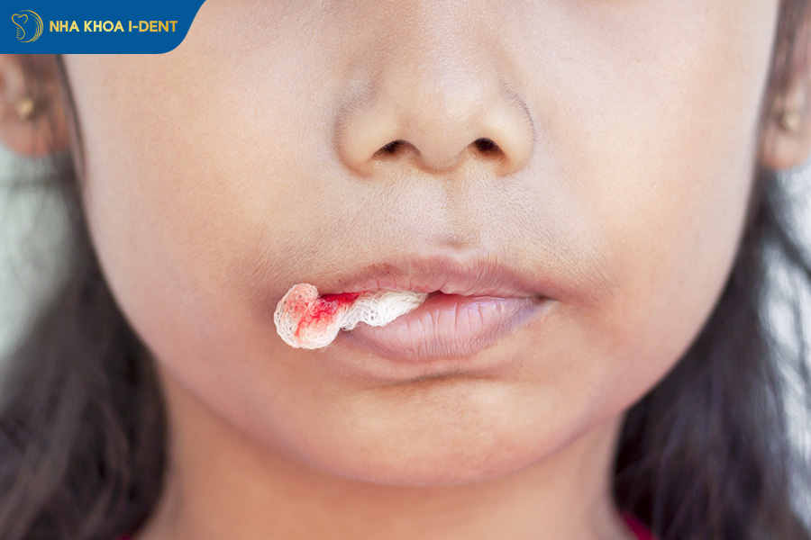 mới nhổ răng xong nên làm gì