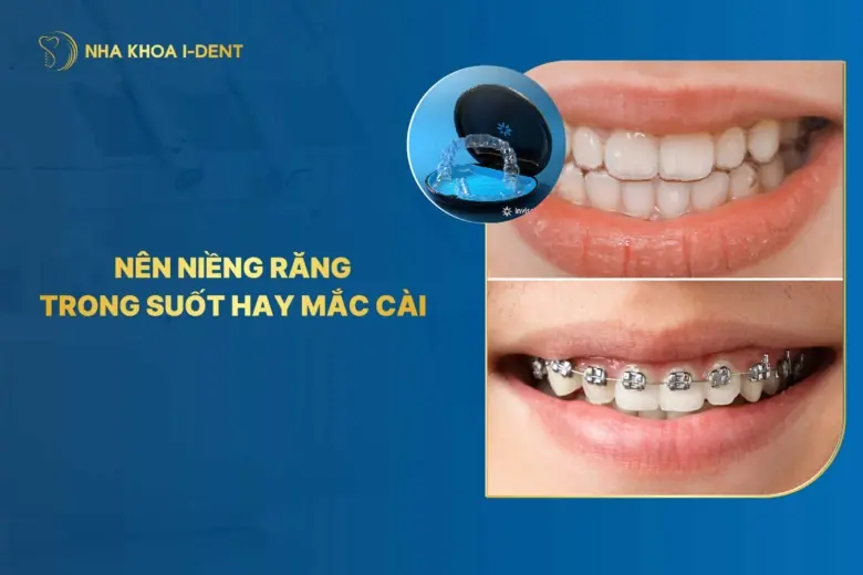 Nên niềng răng trong suốt hay mắc cài? Loại nào tốt?