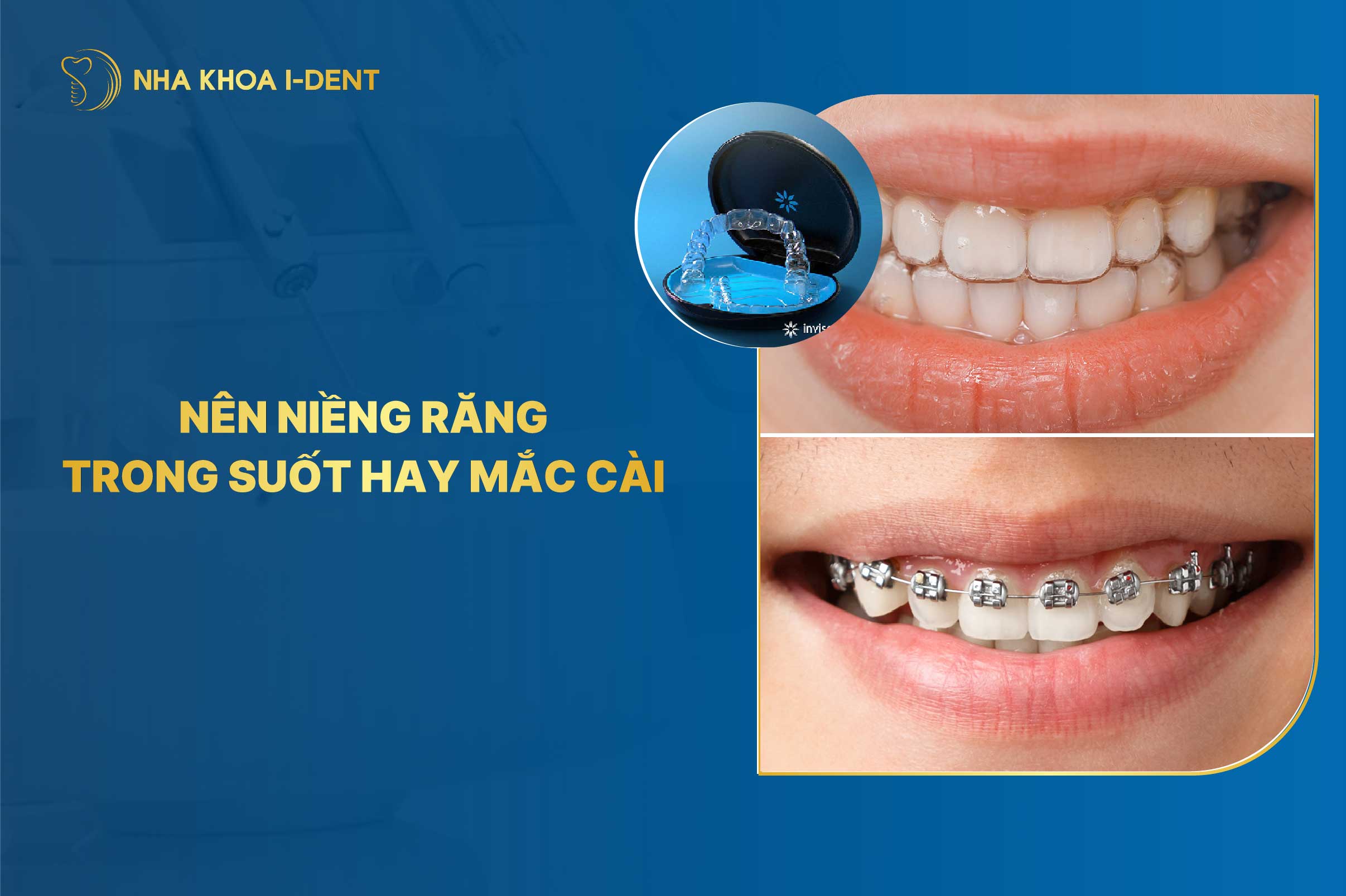 So Sánh Niềng Răng Trong Suốt Và Niềng Răng Mắc Cài