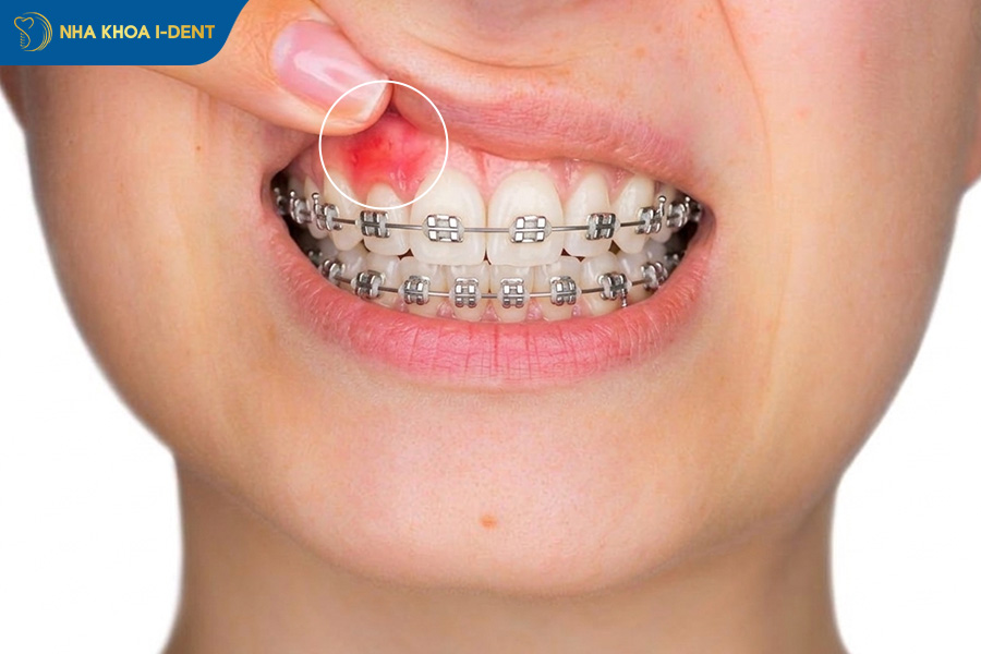 người dị ứng với vật liệu chỉnh nha không nên niềng răng