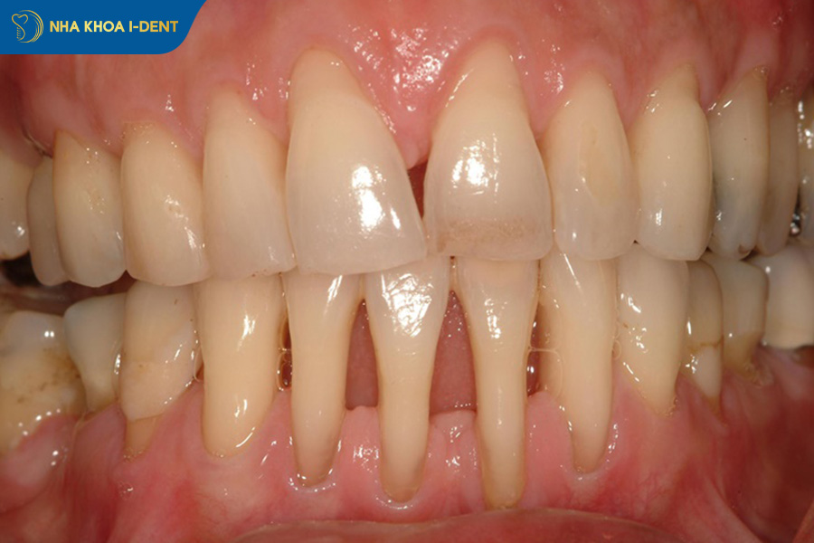 những người không nên niềng răng