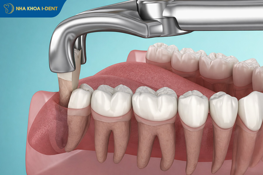 nhổ răng hàm có nguy hiểm không
