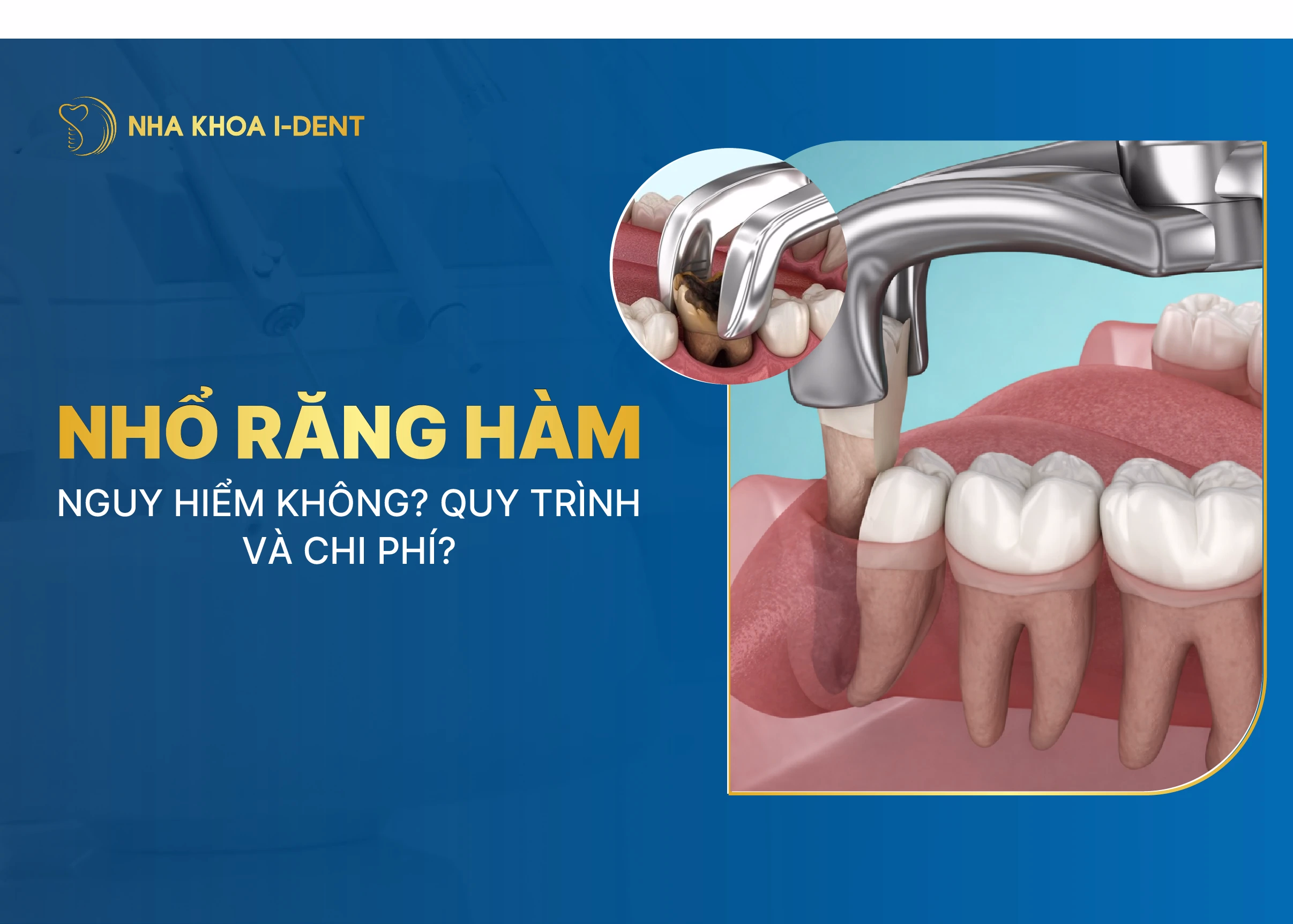 nhổ răng hàm