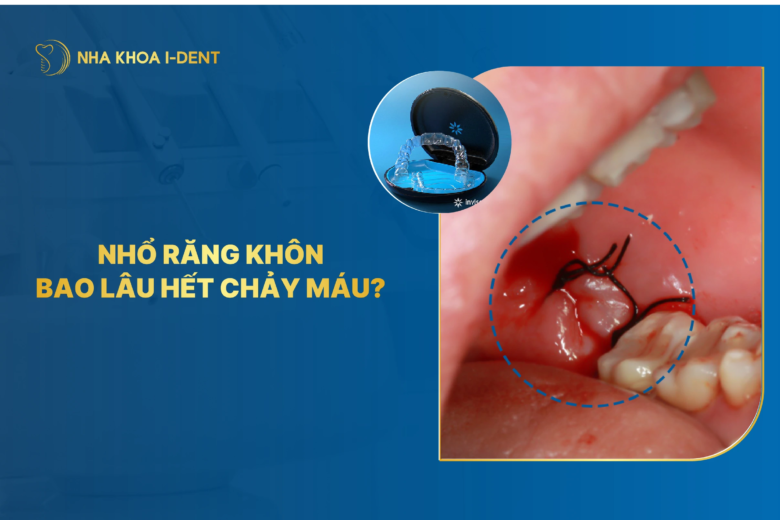 Nhổ răng khôn bao lâu hết chảy máu? 