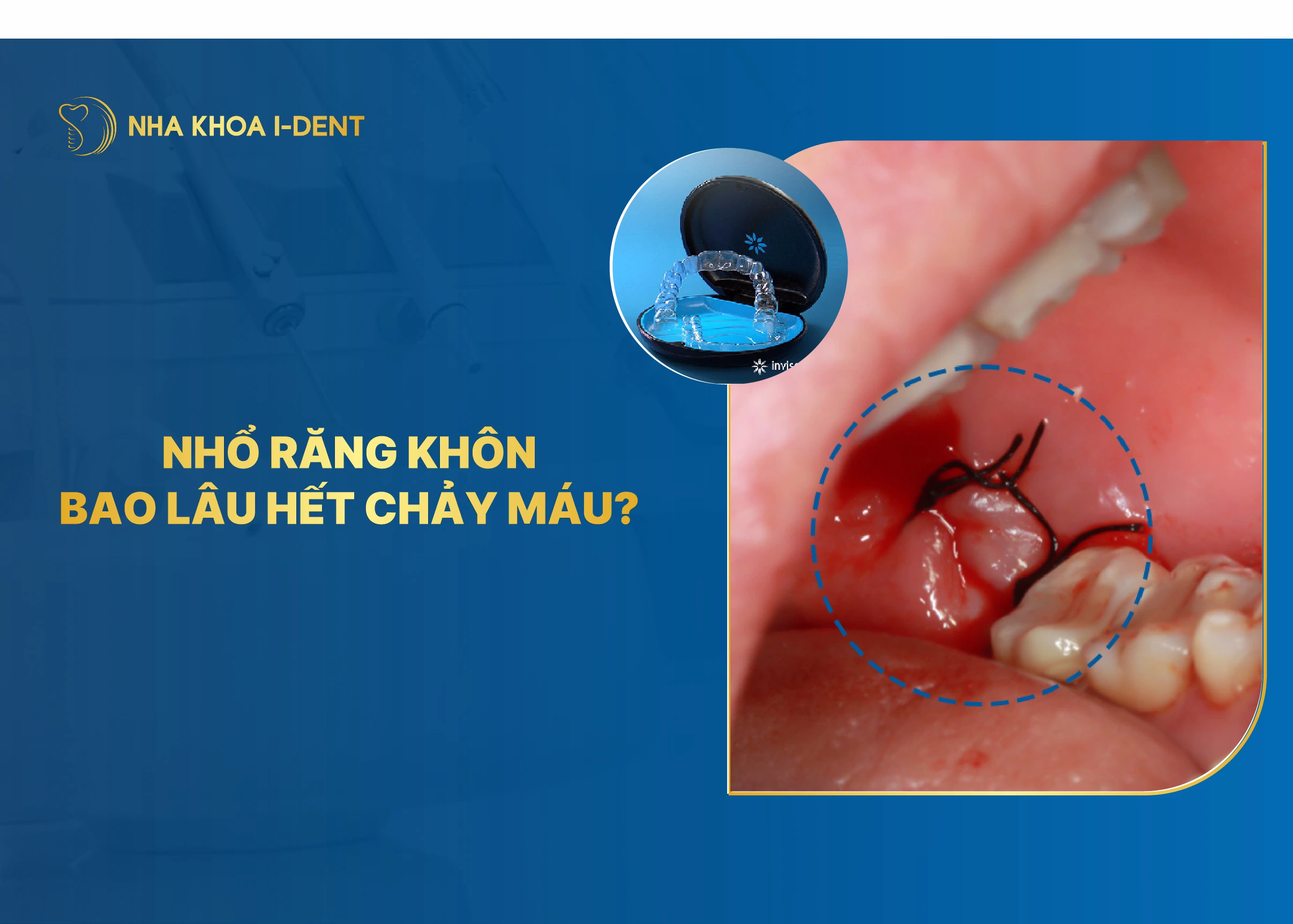 nhổ răng khôn bao lâu hết chảy máu