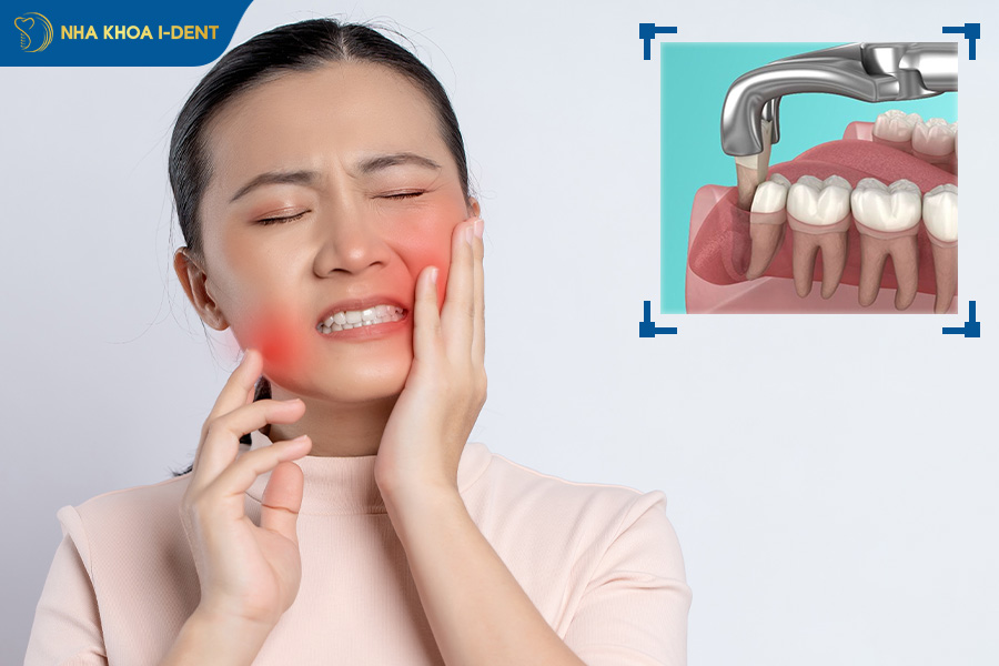 nhổ răng khôn bị sưng