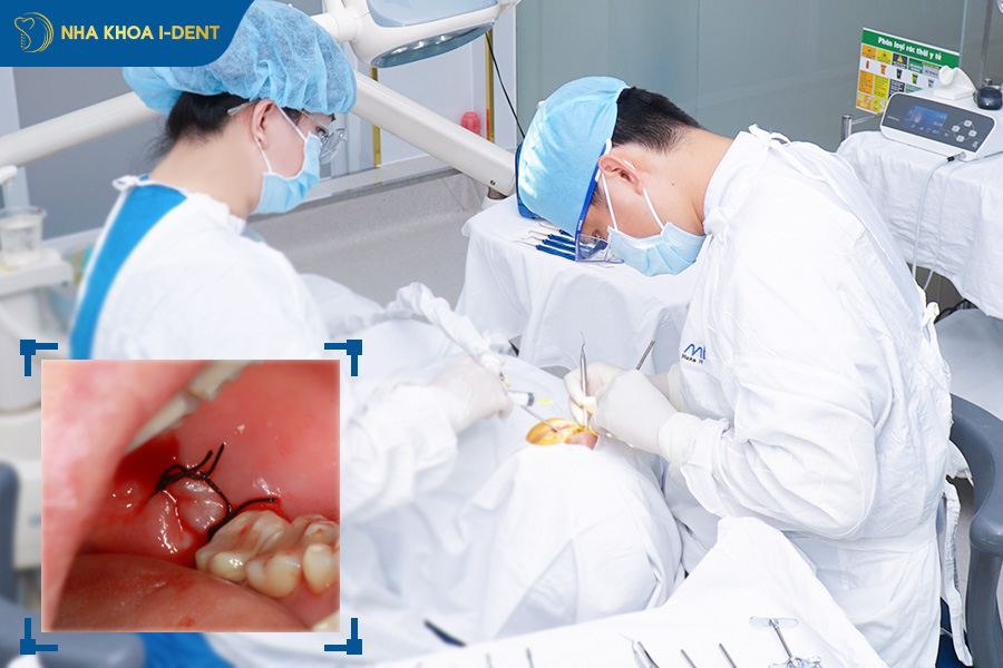 nhổ răng khôn chảy máu bao lâu