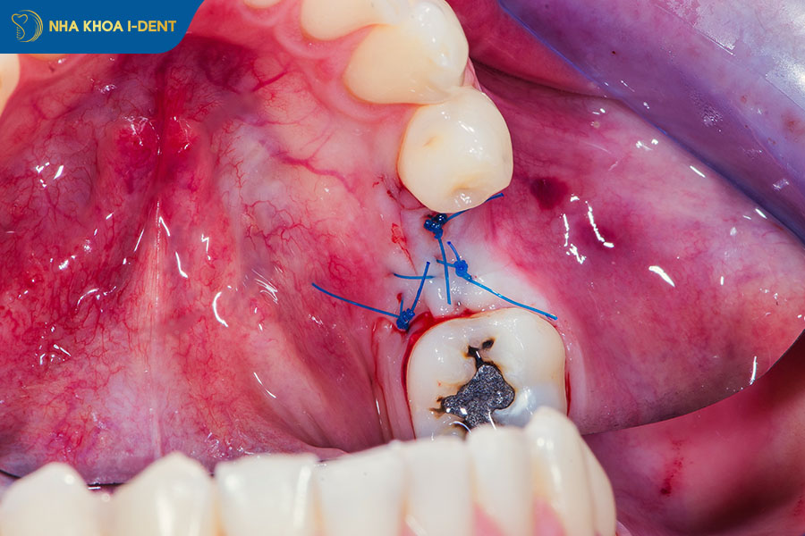 nhổ răng khôn hàm trên