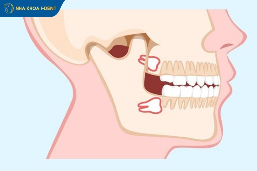 nhổ răng số 8 hàm trên