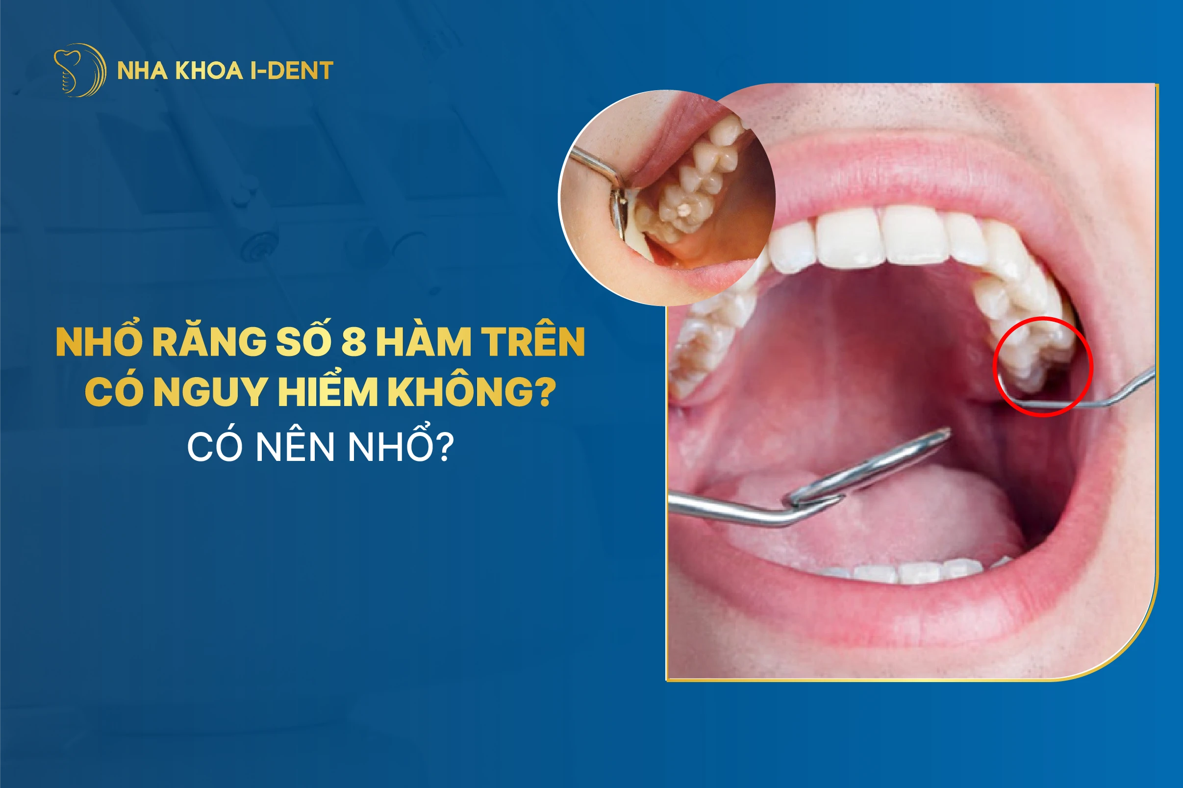 Nhổ răng số 8 hàm trên có nguy hiểm không? Có nên nhổ?
