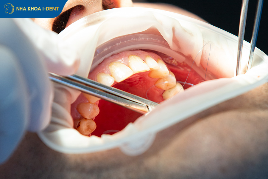nhổ răng trong cùng hàm trên nguy hiểm không
