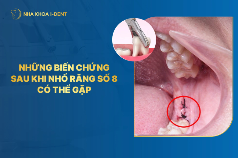 những biến chứng sau khi nhổ răng số 8