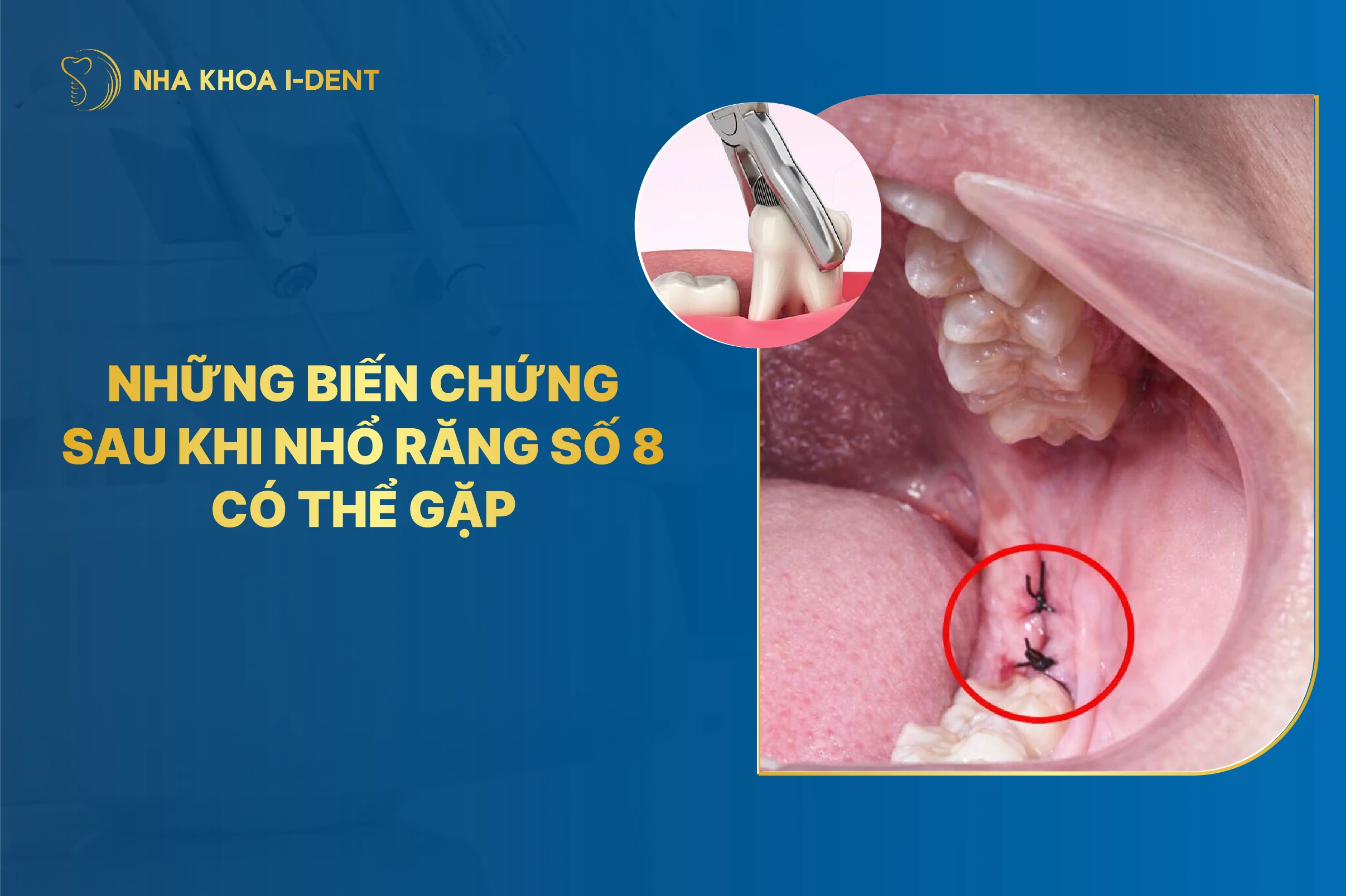 Những biến chứng sau khi nhổ răng số 8 có thể gặp và cách điều trị