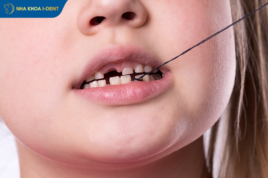 những cách nhổ răng không đau tại nhà