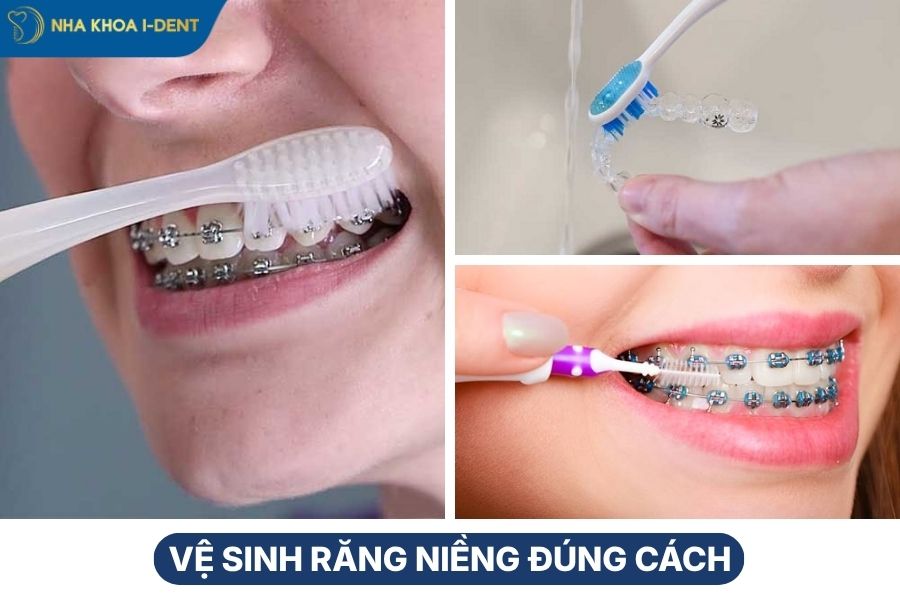 điều nên biết khi niềng răng