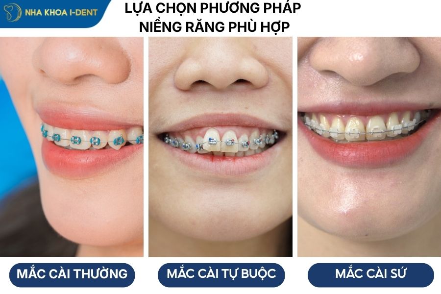 những điều cần biết trước khi niềng răng