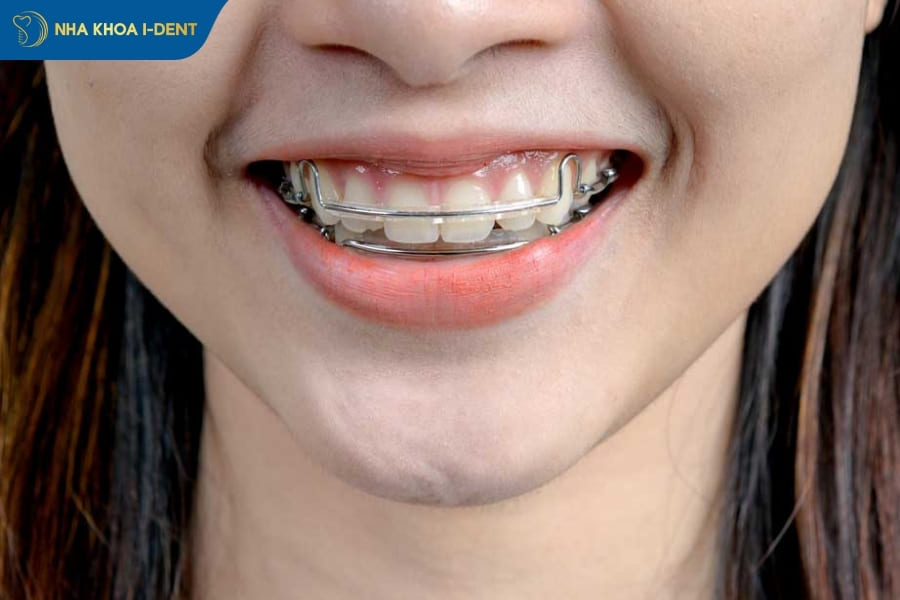 các lưu ý khi niềng răng