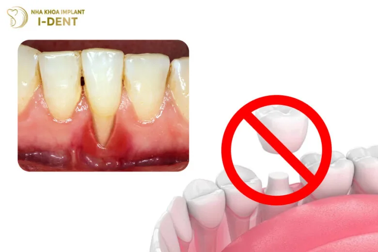 những trường hợp không nên bọc răng sứ