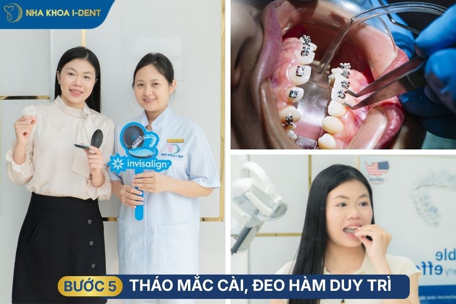 niềng răng khớp cắn sâu